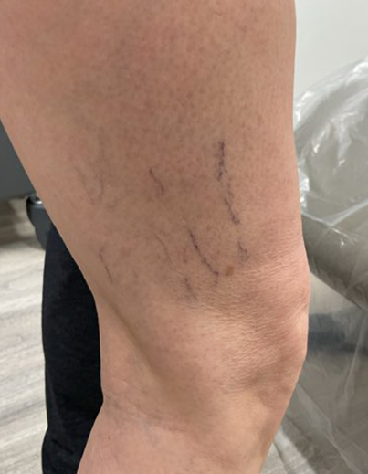 Spider Veins — Right Leg - Before
